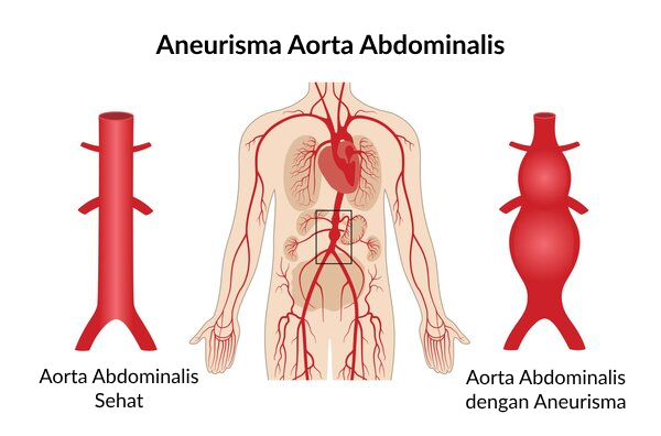 Ilustrasi Aneurisma Aorta Abdominalis