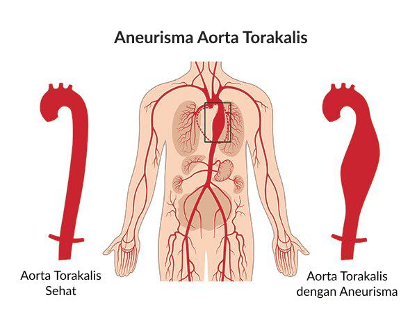 Ilustrasi Aneurisma Aorta Torakalis