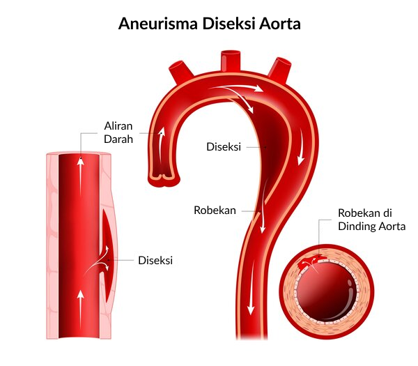 Ilustrasi Aneurisma Diseksi Aorta