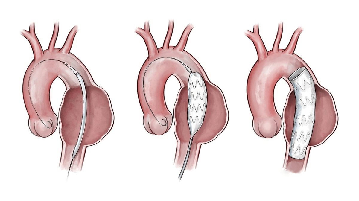 Ilustrasi Thoracic Endovascular Aneurysm Repair (TEVAR)