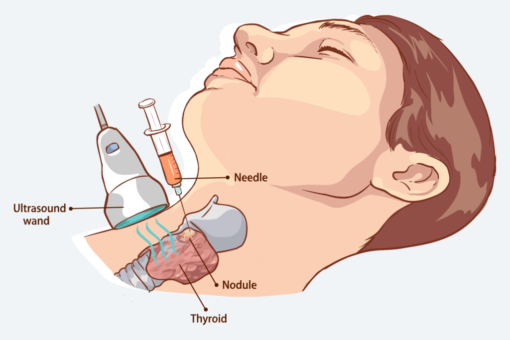 Metode Diagnosis Penyakit Tiroid Menggunakan Biopsi Jarum Halus