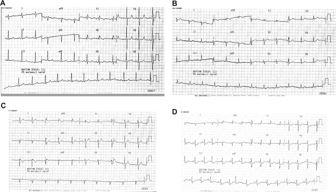 Hasil Diagnosis Atrial Septal Defect (ASD) dengan EKG