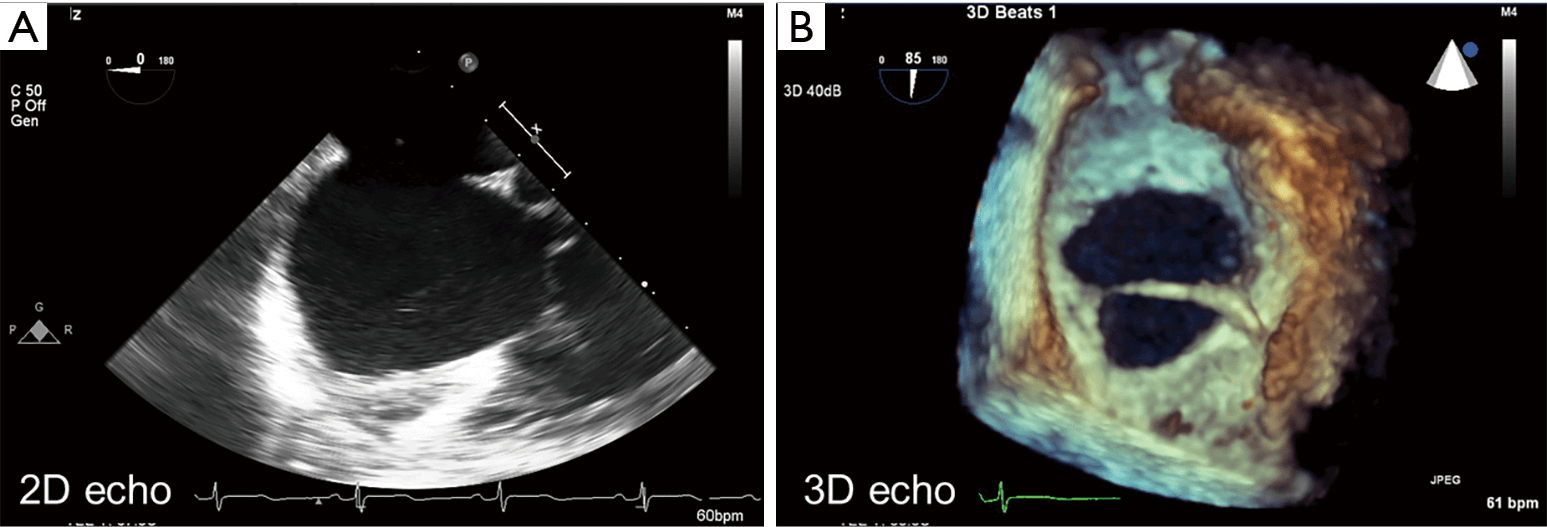 Hasil Diagnosis Atrial Septal Defect (ASD) dengan Ekokardiografi