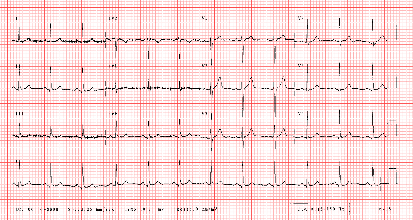 Hasil EKG yang Normal