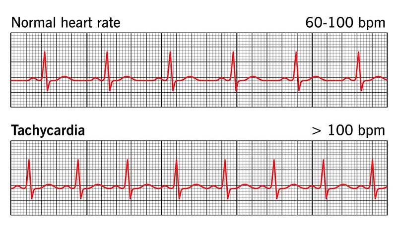 Ilustrasi EKG Kondisi Detak Jantung Normal dan Detak Jantung pada Kondisi Tachycardia