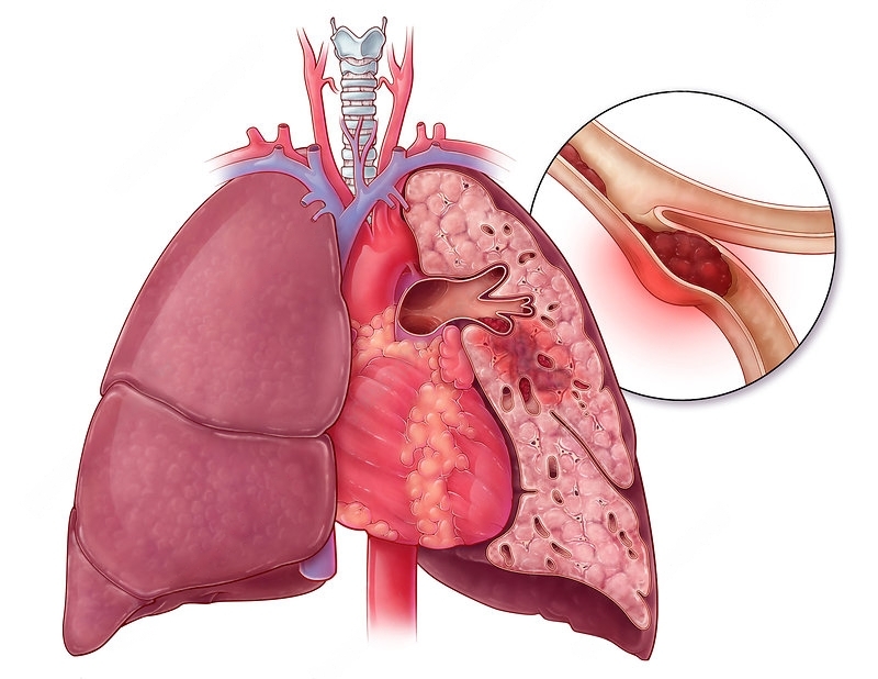 Gambar Ilustrasi Emboli Paru