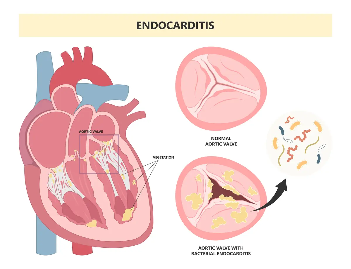 Ilustrasi Jantung dengan Endokarditis