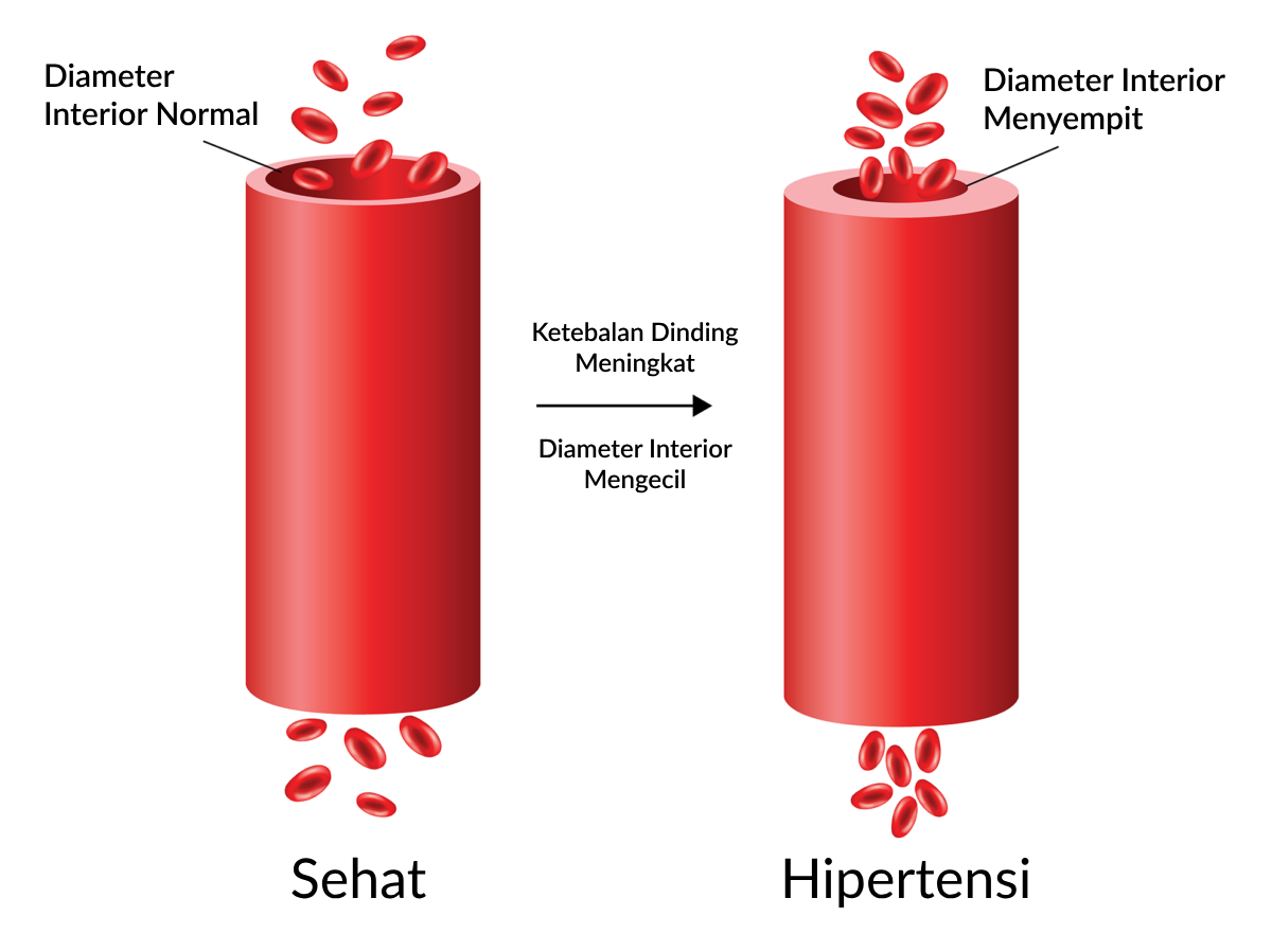 Ilustrasi Hipertensi (Tekanan Darah Tinggi)