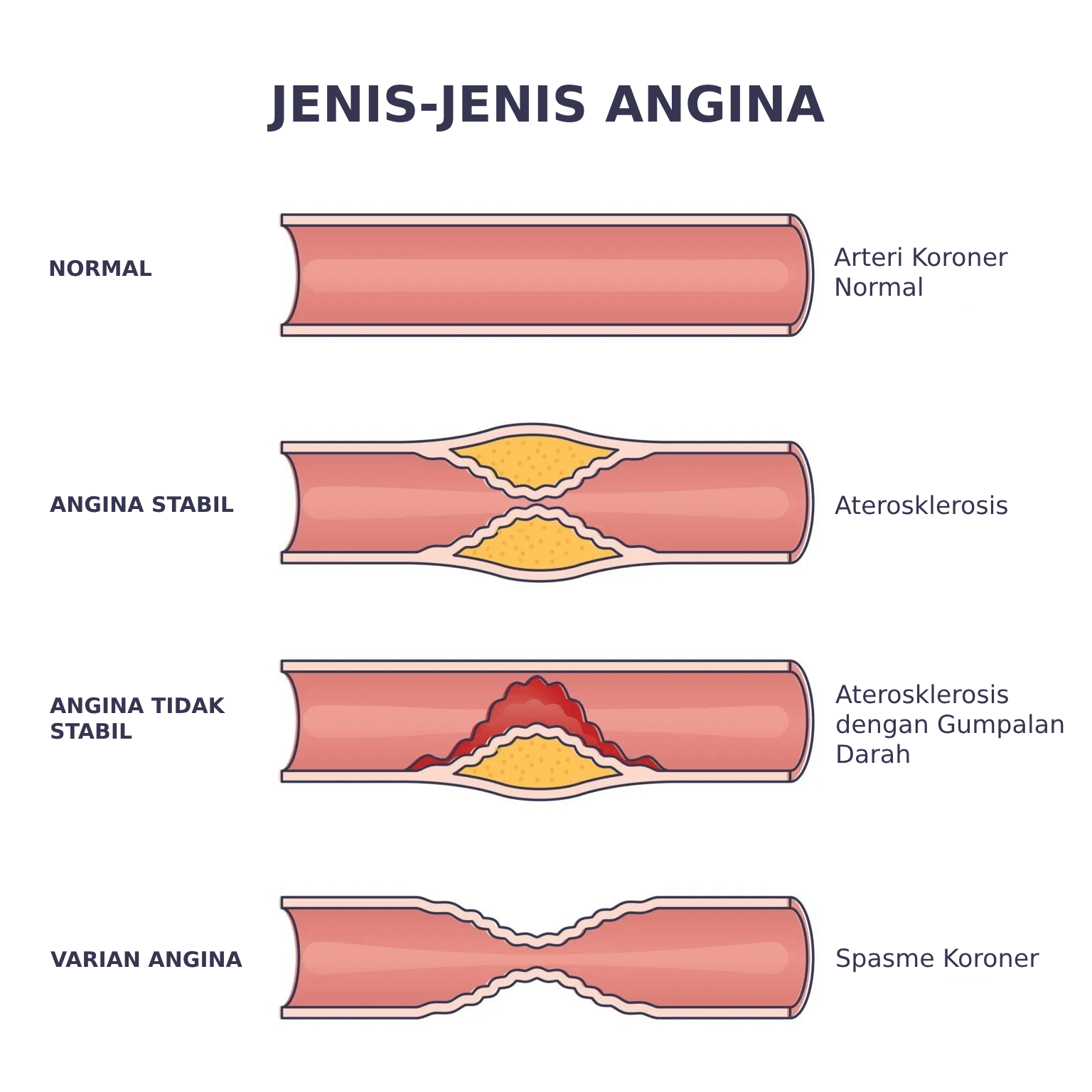 Ilustrasi Jenis-Jenis Angina