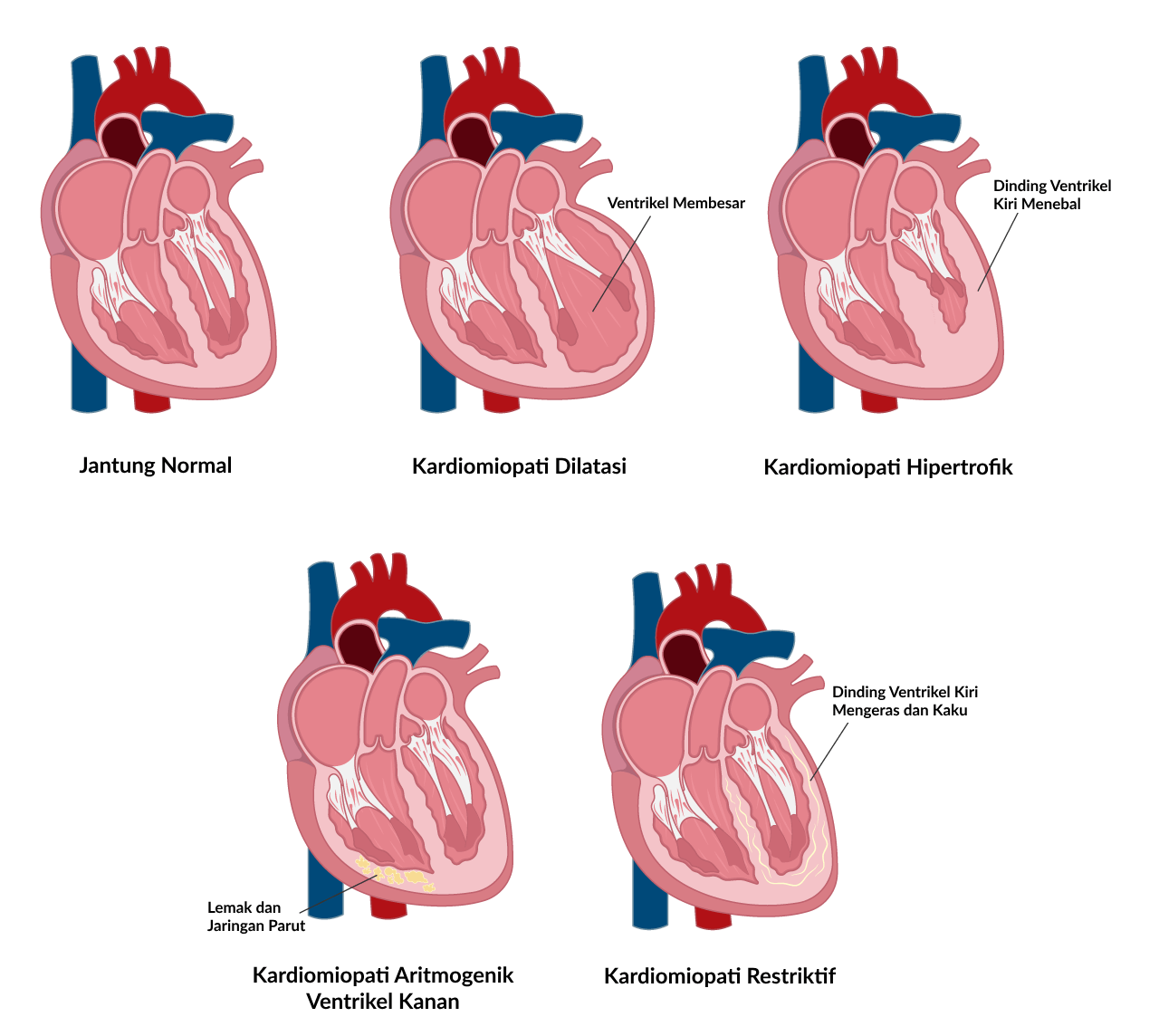 Ilustrasi Perbandingan Kondisi Jantung Normal dan Jantung Pengidap Kardiomiopati