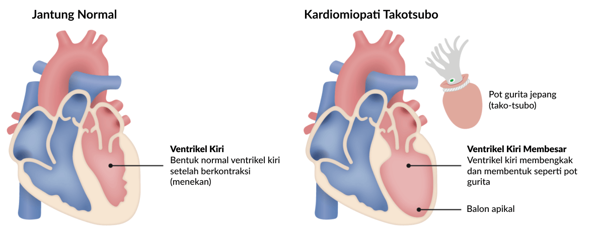 Ilustrasi Perbandingan Kondisi Jantung Normal dan Jantung Pengidap Kardiomiopati Takotsubo