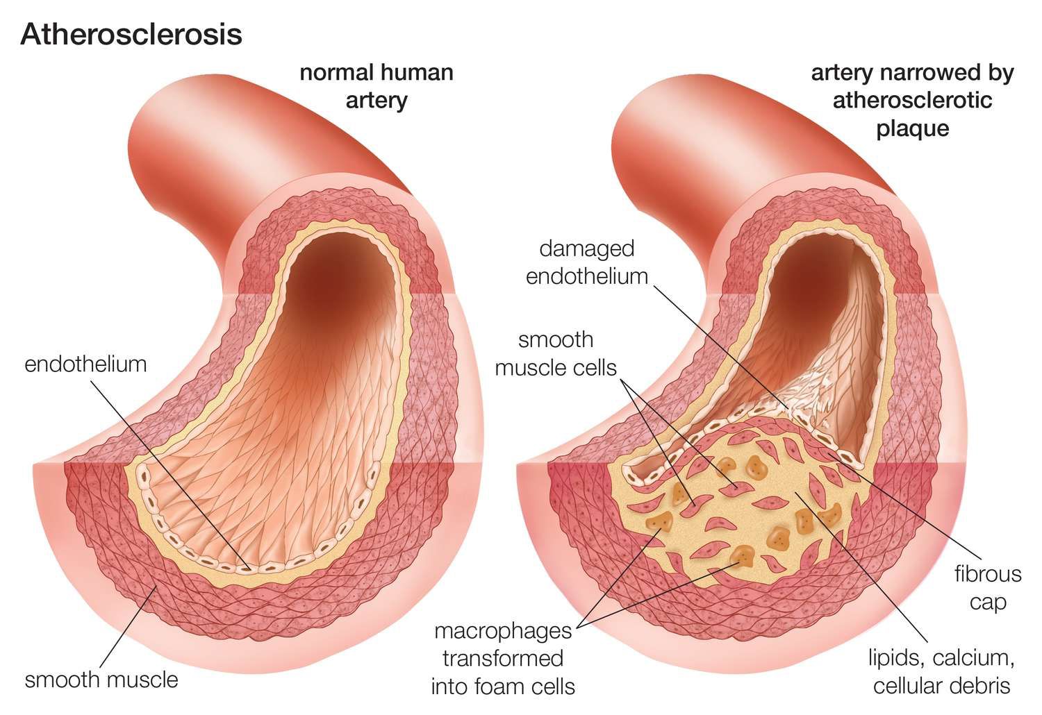 Ilustrasi Pembuluh Darah Kondisi Norman dan Aterosklerosis