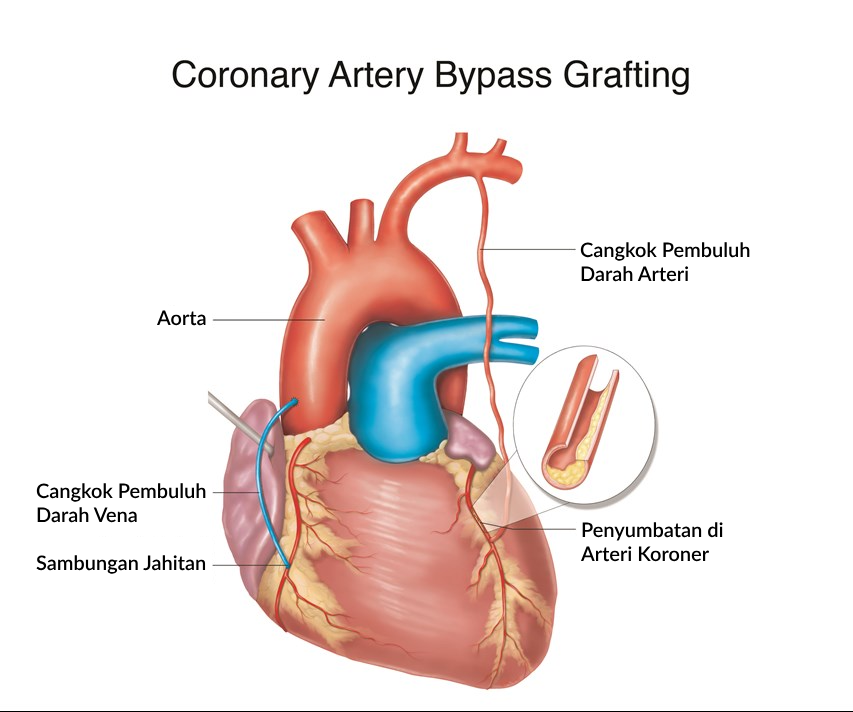 Ilustrasi Prosedur Operasi Bypass Jantung (CABG)