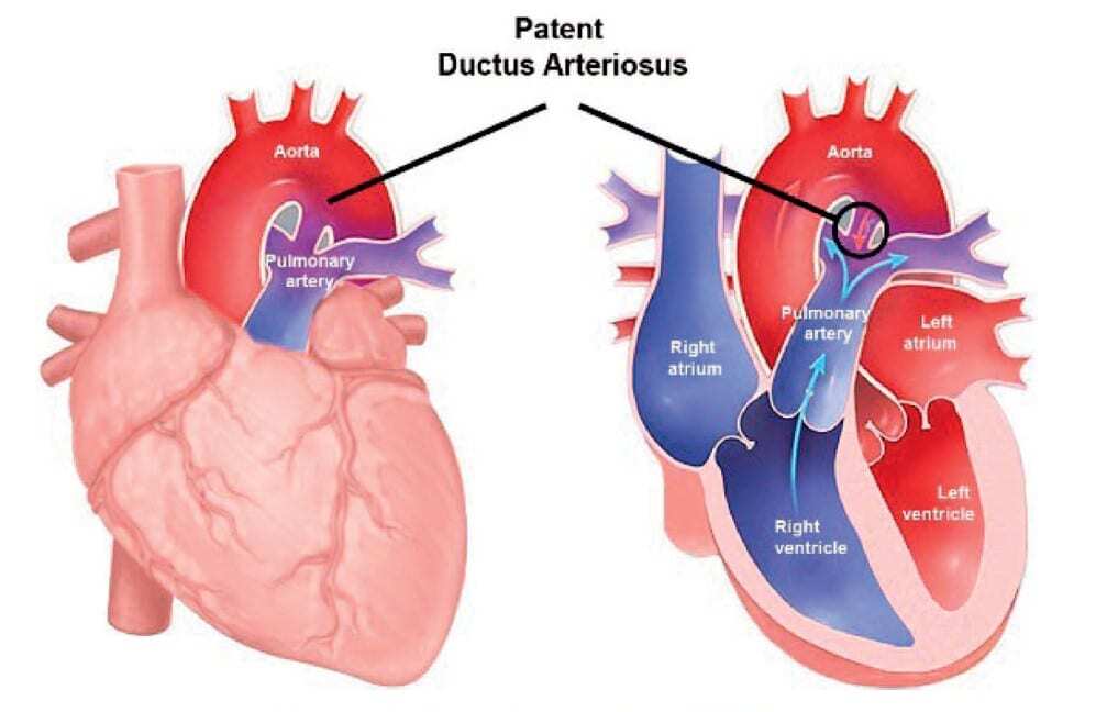 Ilustrasi Jantung dengan Penyakit Patent Ductus Arteriosus (PDA)