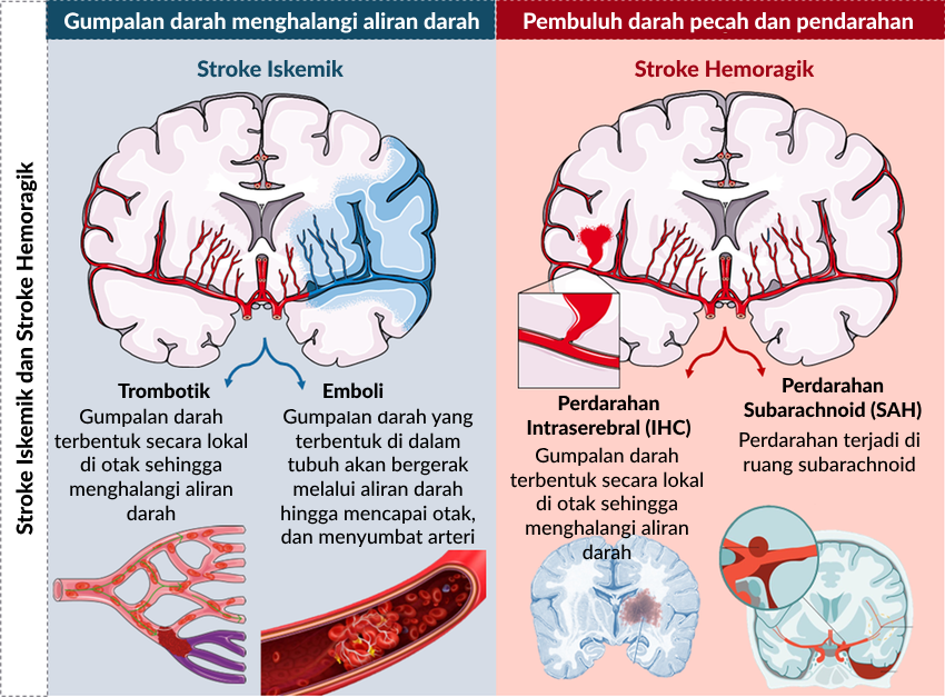 Ilustrasi perbandingan stroke iskemik dan stroke hemoragik