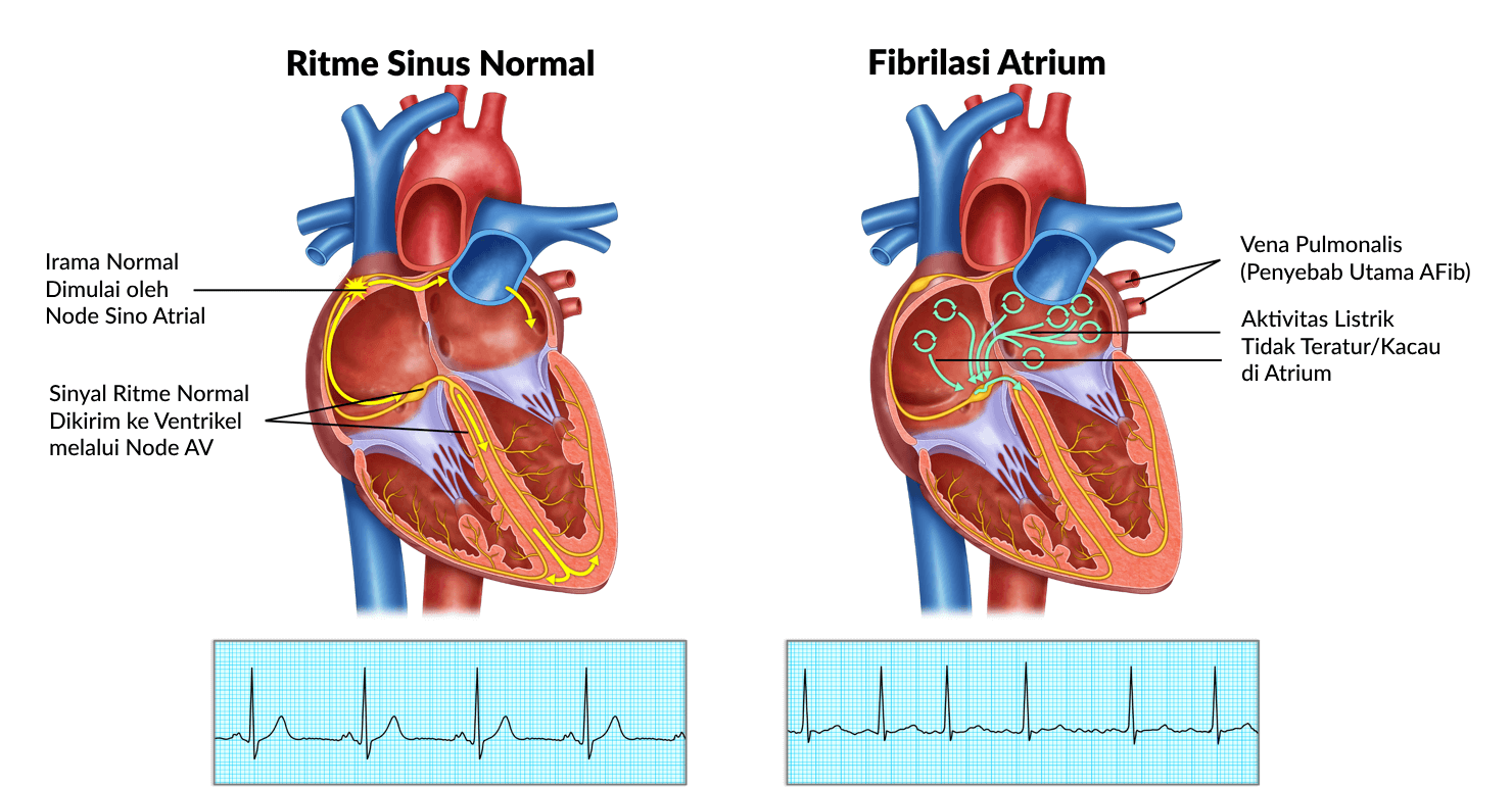 Gambar Ilustrasi Perbedaan Kondisi Jantung Normal dan Fibrilasi Atrium