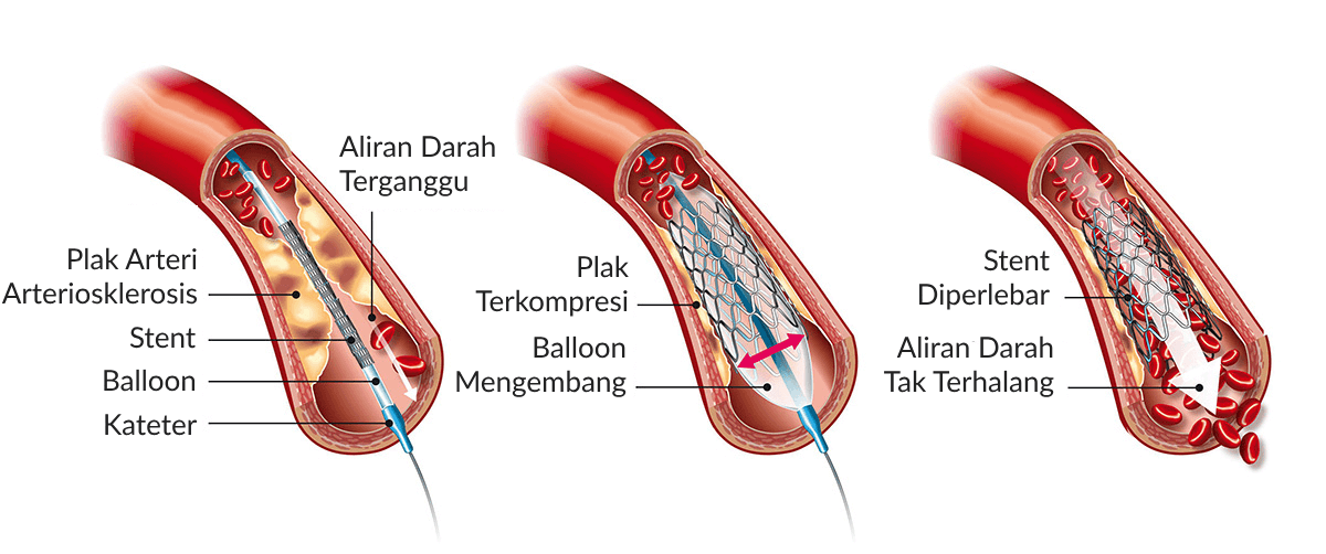 Prosedur Pemasangan Stent pada Penyakit Jantung Koroner