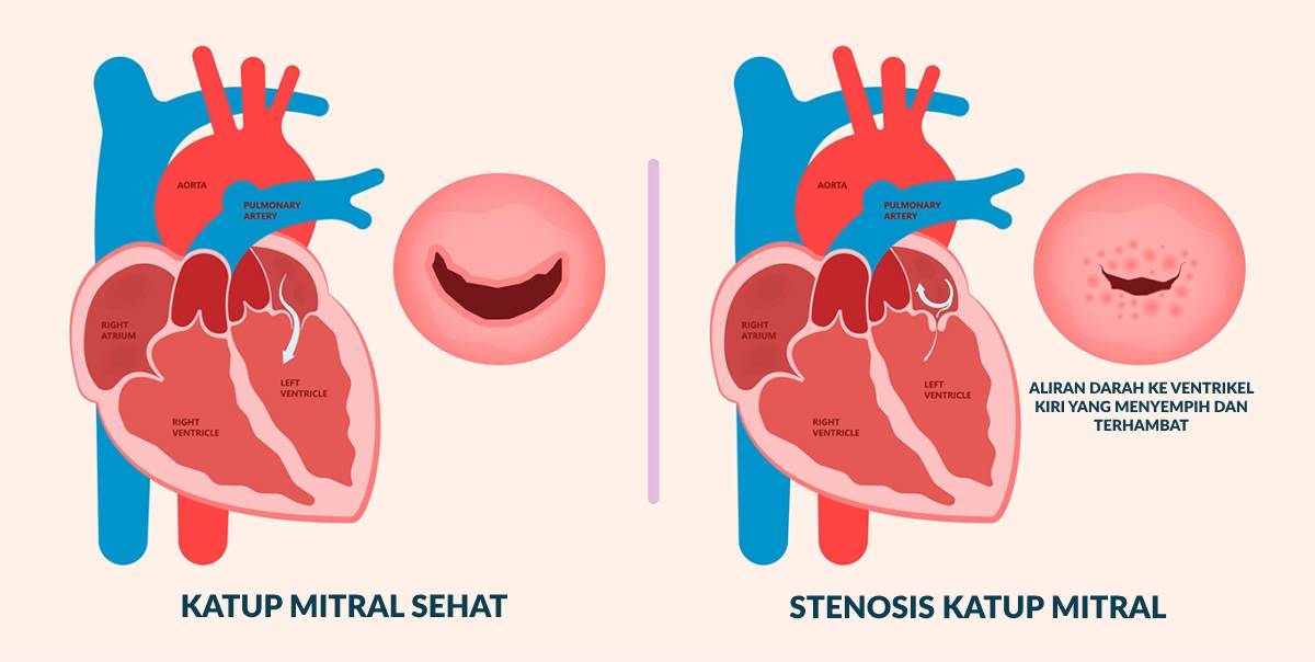 Ilustrasi Stenosis Katup Mitral