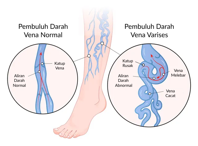 Bagaimana Varises Terbentuk