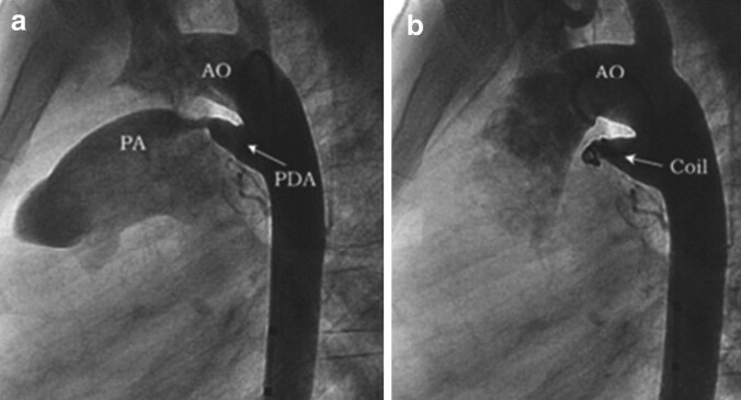 Penutupan Patent Ductus Arteriosus (PDA) dengan Coil